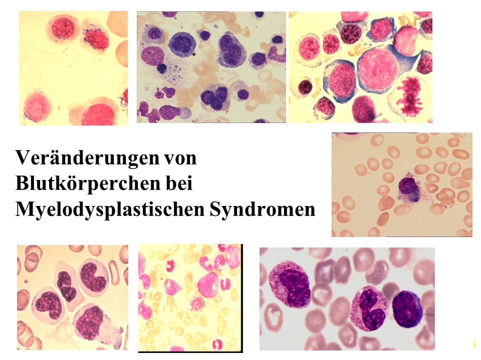 Blutzellen beim MDS